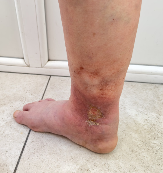 Varicose Veins